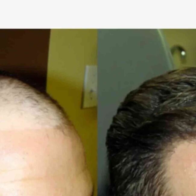 Hair Transplant Turkey